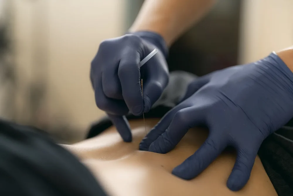 Dry needling treatment at Ian The Chiro clinic, Cheras Kuala Lumpur